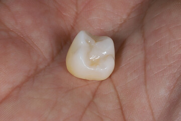 Bridge crown prosthesis treatment in dental aesthetic dentistry for missing teeth. Zirconium porcelain bridge treatment and E-max porcelain tooth coating. © UniqDream