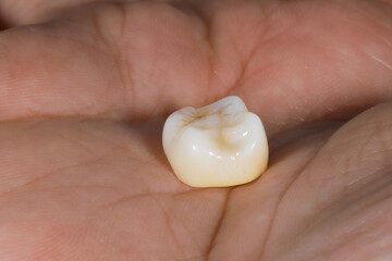 Bridge crown prosthesis treatment in dental aesthetic dentistry for missing teeth. Zirconium porcelain bridge treatment and E-max porcelain tooth coating. © UniqDream