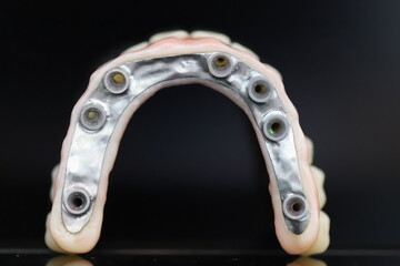Full-arch porcelain implant-supported dental prosthesis for edentulous jaws with All-on-X and...
