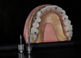 Full-arch porcelain implant-supported dental prosthesis for edentulous jaws with All-on-X and...