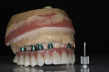 Full-arch porcelain implant-supported dental prosthesis for edentulous jaws with All-on-X and...
