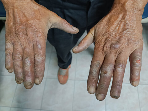Conditions of the skin and dermatitis on the hand of leprosy patients which looks like blisters and the patient will have numbness. Wound of leprosy patient.