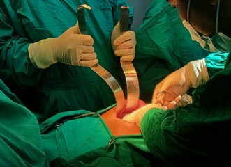 Surgery of abdominal, Resection of Small Bowels with Ligation of vessels during operation. Step by step surgery.
