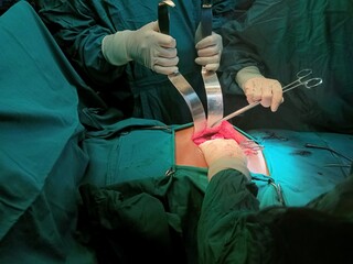 Surgery of abdominal, Resection of Small Bowels with Ligation of vessels during operation. Step by step surgery.