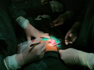 Surgery of abdominal, Resection of Small Bowels with Ligation of vessels during operation. Step by step surgery.