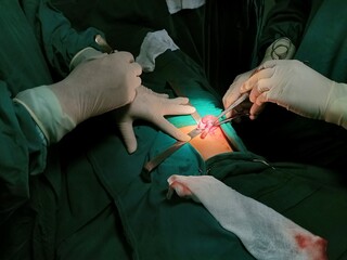 Surgery of abdominal, Resection of Small Bowels with Ligation of vessels during operation. Step by step surgery.