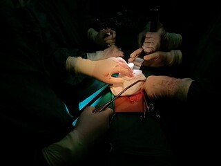 Surgery of abdominal, Resection of Small Bowels with Ligation of vessels during operation. Step by step surgery.