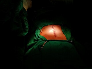 Surgery of abdominal, Resection of Small Bowels with Ligation of vessels during operation. Step by step surgery.
