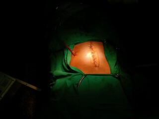 Surgery of abdominal, Resection of Small Bowels with Ligation of vessels during operation. Step by step surgery.