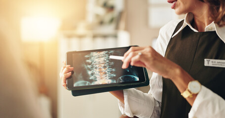 Doctor, hands and xray on tablet in clinic for explaining medical diagnosis, spinal tumor and cancer cells. Neurologist, woman and digital screen for anatomy scan, surgery feedback and health support