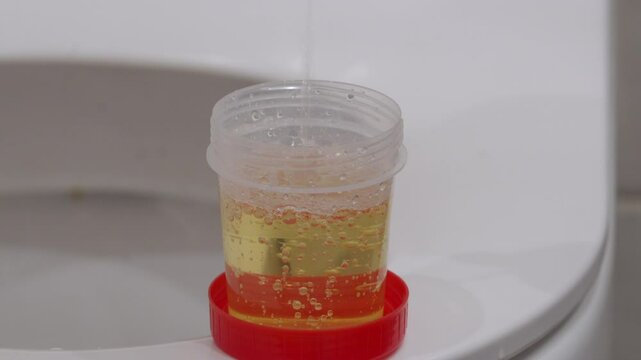 Person filling urine sample container in toilet. Man peeing in urine test plastic container. Medical urine test. Drug testing.