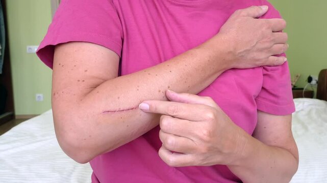 Treating a deep cut on the hand  Scar on hand. Cut and wound in the skin..