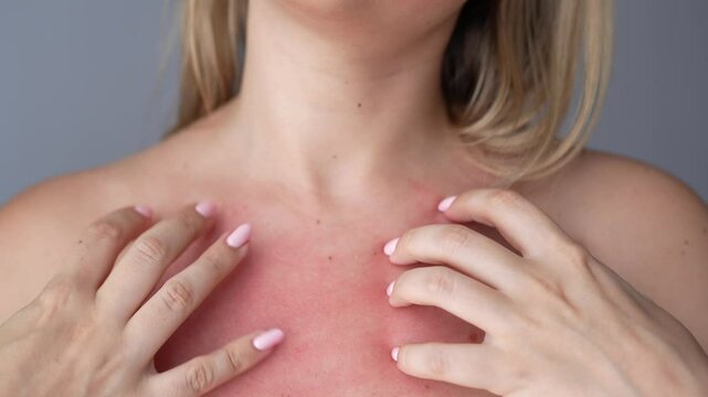 Young caucasian blonde woman with a red allergic rash on her chest scratching the skin with her hands on a dark grey background. Food allergies. Severe allergic reaction, itching