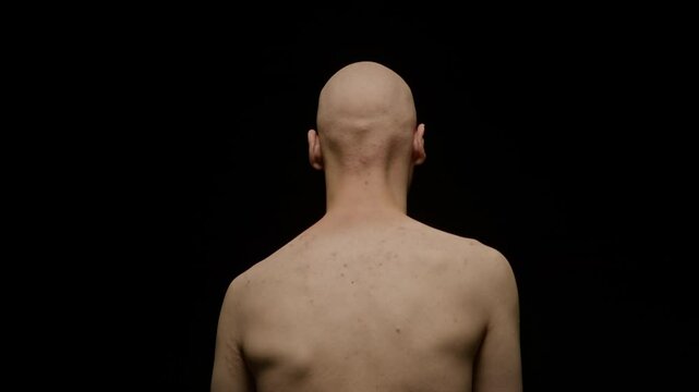 Back view medium portrait of shirtless young man with alopecia standing against deep black studio background with bare back and moving his sharp shoulder blades, symbolizing vulnerability
