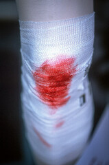 Bleeding knee with gauze bandage