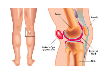 Medical illustration of baker cyst, with annotation.