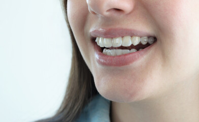 Boca de chica sonriendo con tratamiento de ortodoncia invisalign, alineadores dentales...