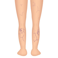 The external sign of dilated skin vessels. Symptoms of vascular lesions of the legs. Varicose veins