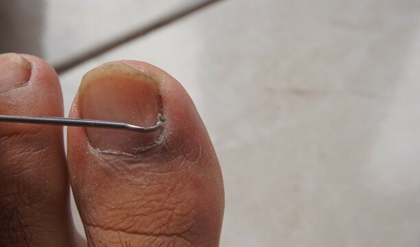 photo of big toe being cleaned of dirt using a nail cleaner