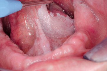 leukoplakia