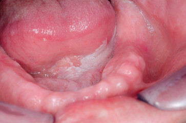 Leukoplakia
