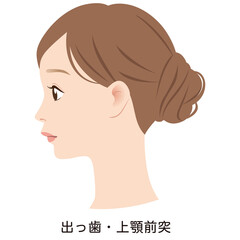 上顎突出の口元　出っ歯　Eライン　横顔 © koti