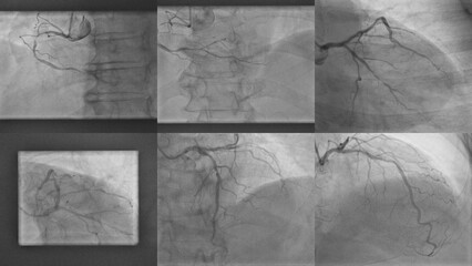Coronary Angiogram Results: Right Coronary Artery (RCA), Left Anterior Descending Artery (LAD), and Left Circumflex Artery (LCX) Evaluation for Cardiovascular Health