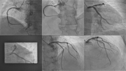 Normal Coronary Angiogram of Left and Right Coronary Arteries: Cardiac Catheterization Results for...