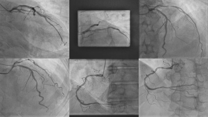 Coronary Angiogram (CAG): Evaluation of Right Coronary Artery (RCA), Left Circumflex (LCX), and...