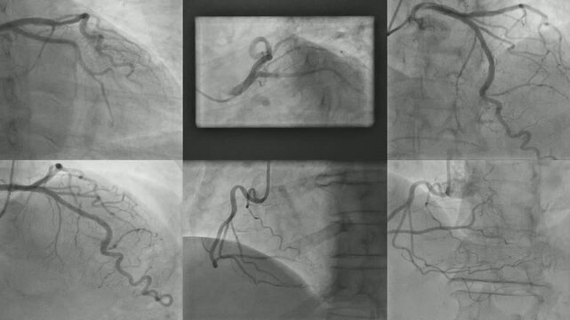 Coronary angiogram (CAG)