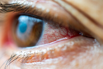 Extremely close-up shot of the veins of an eye with glaucoma.
