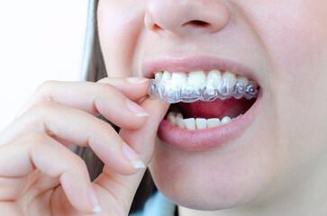 Colocación de alineadores transparentes y removibles. Tratamiento dental con ortodoncia...