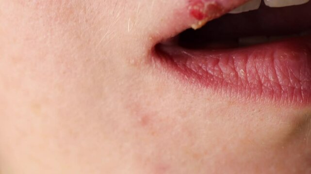Healing cold sore on lip. close-up of herpes infection. Herpes blister showing redness and crushing during viral outbreak. 