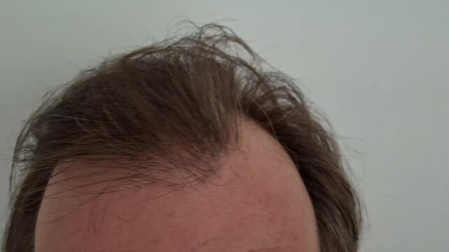 Hair loss man. Close-up of Hair Loss on a Man's Scalp