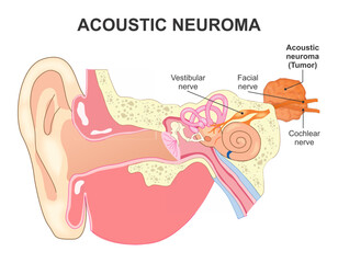 Obraz premium Acoustic Neuroma Tumor Illustration ENT