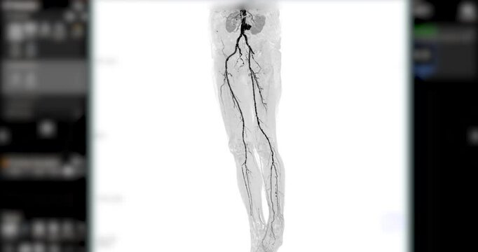 3D CTA of Lower Extremities Footage:
A clear 3D visualization of the femoral artery and lower body skeleton, supporting vascular and orthopedic assessment.