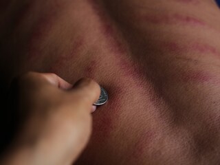 scraping is a habit of Indonesian citizens to cure colds, by scraping using coins and massage oil