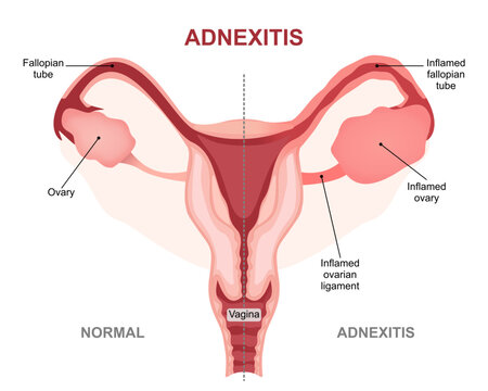 Adnexitis inflammated fallopian tubes and ovaries Illustration
