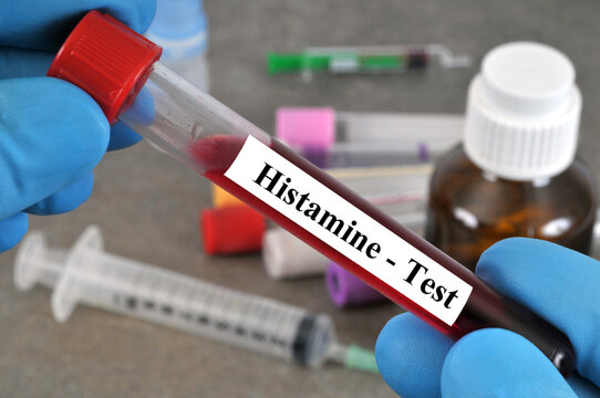 Tube de sang pour conna&icirc;tre le taux d'histamine tenu par une main gant&eacute;e