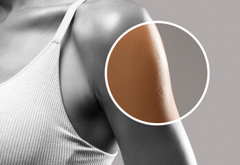 Scar on a woman's arm after vaccination.