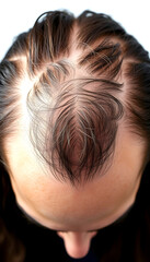 Naklejka premium Close-up of a scalp, before and after hair regeneration, showcasing the miracle of modern beauty treatments, grunge, with white tones