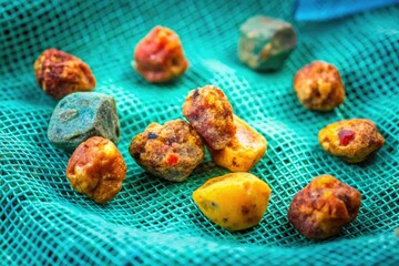 Post-operative laparoscopic cholecystectomy image showing gallstones inadvertently left on surgical gauze.