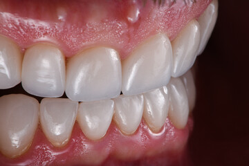 ceramic crowns veneers and implants