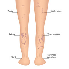 Human legs with health problems. Varicose veins. Bruise, hematoma.