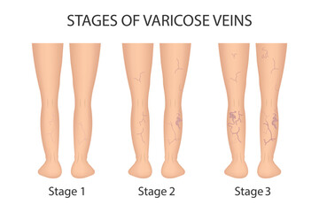 Human legs. Stages of vein disease. Varicose veins. Medical infographics