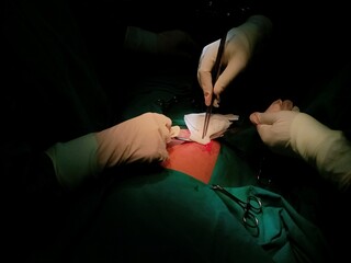 Appendix specimen from appendectomy, after surgery from the doctor.	
