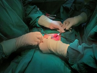Appendix specimen from appendectomy, after surgery from the doctor.	
