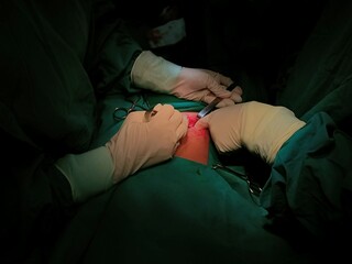 Appendix specimen from appendectomy, after surgery from the doctor.	
