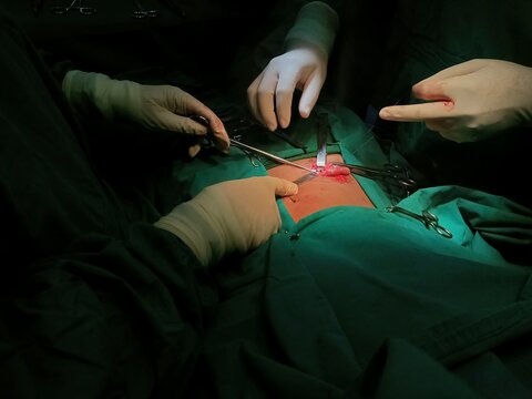 Appendix specimen from appendectomy, after surgery from the doctor.	
