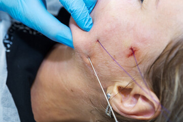 Close-up anti-age facial lifting procedure using PDO threads of polylactic acid applied in the face with aseptic cannula before extending skin
